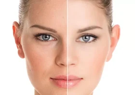 Enlever les taches brunes sur la peau du visage