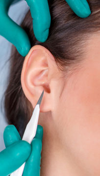 otoplastie