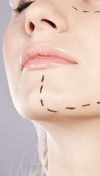 Génioplastie